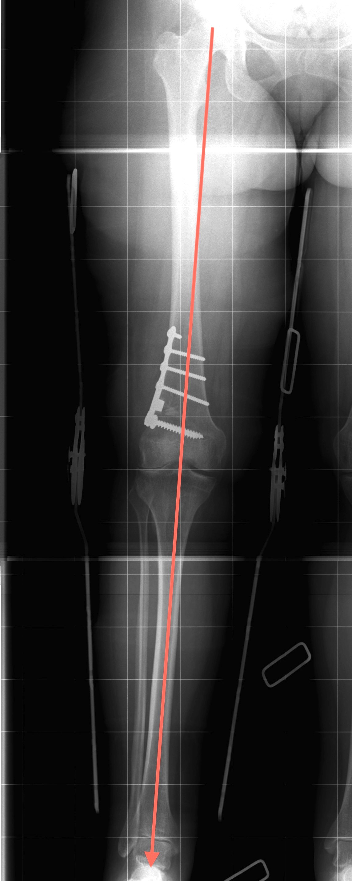 Distal Femoral Osteotomy Postop View